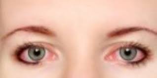 5 نصائح يجب اتباعها لتجنب مشاكل جفاف العين