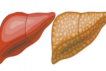 إشارات يرسلها الجسم تدل على وجود السموم في الكبد