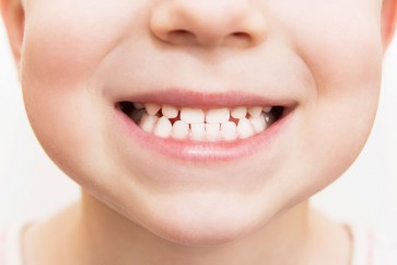 طريقة تحمي الأسنان اللبنية من التسوس