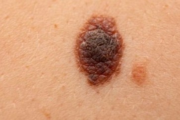 Skin Cancer1